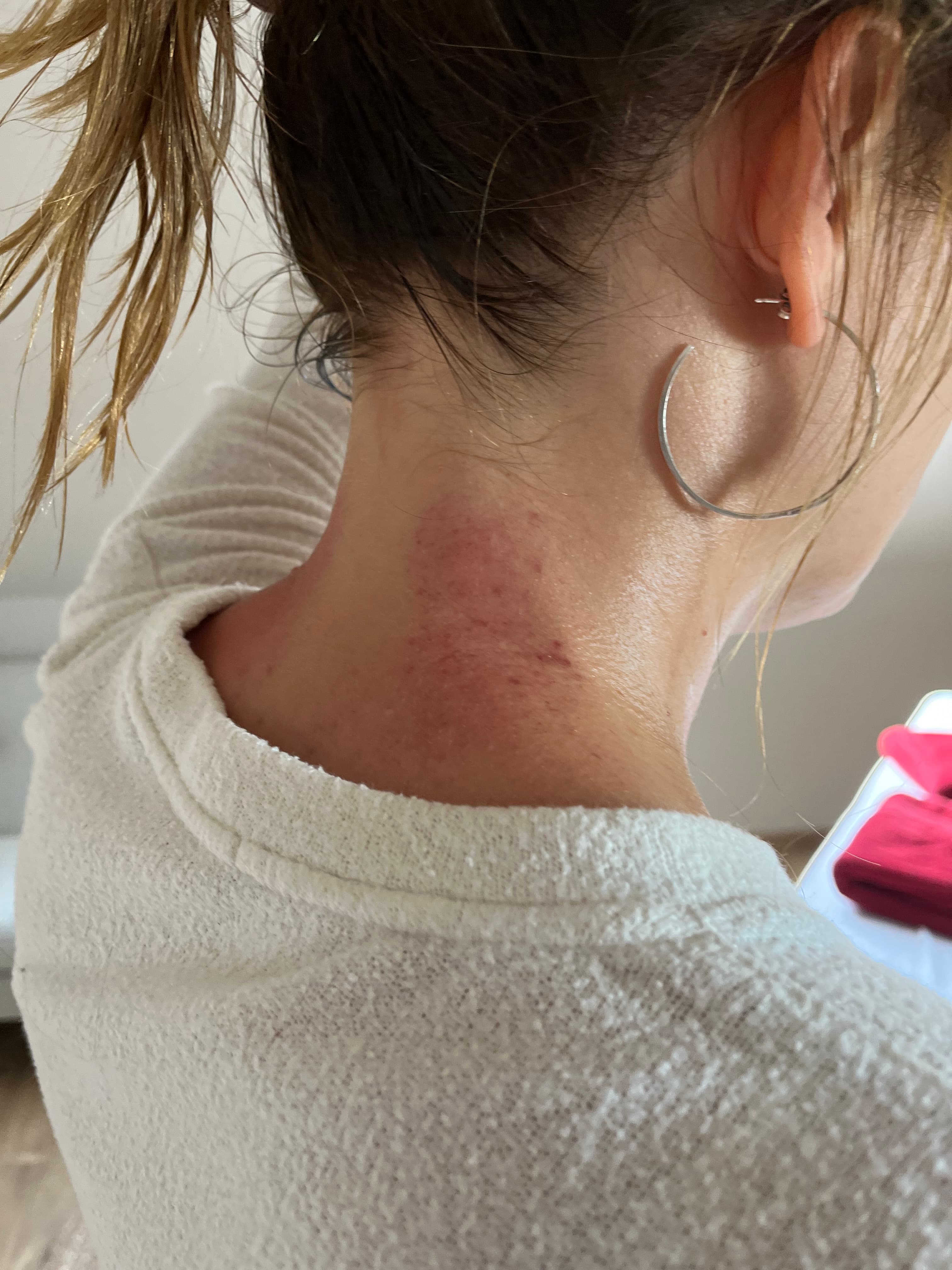 Is cupping pijnlijk? Laat je niets aanpraten